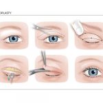 What is an eyelid correction
