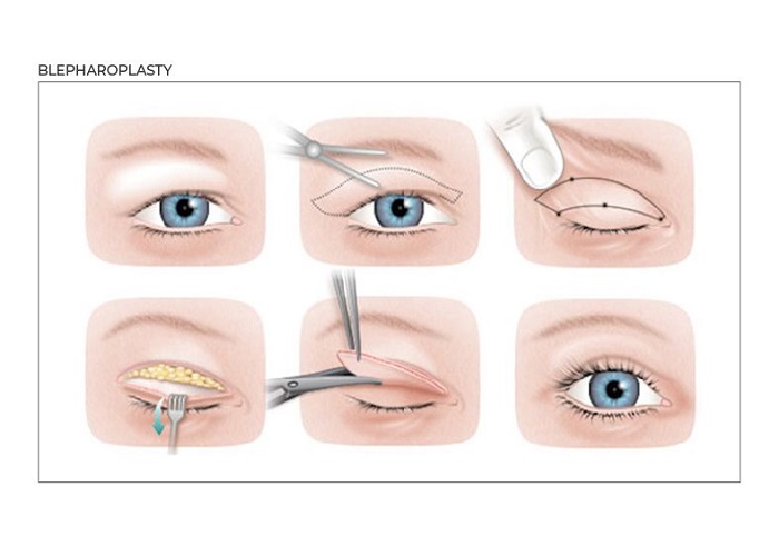 What is an eyelid correction